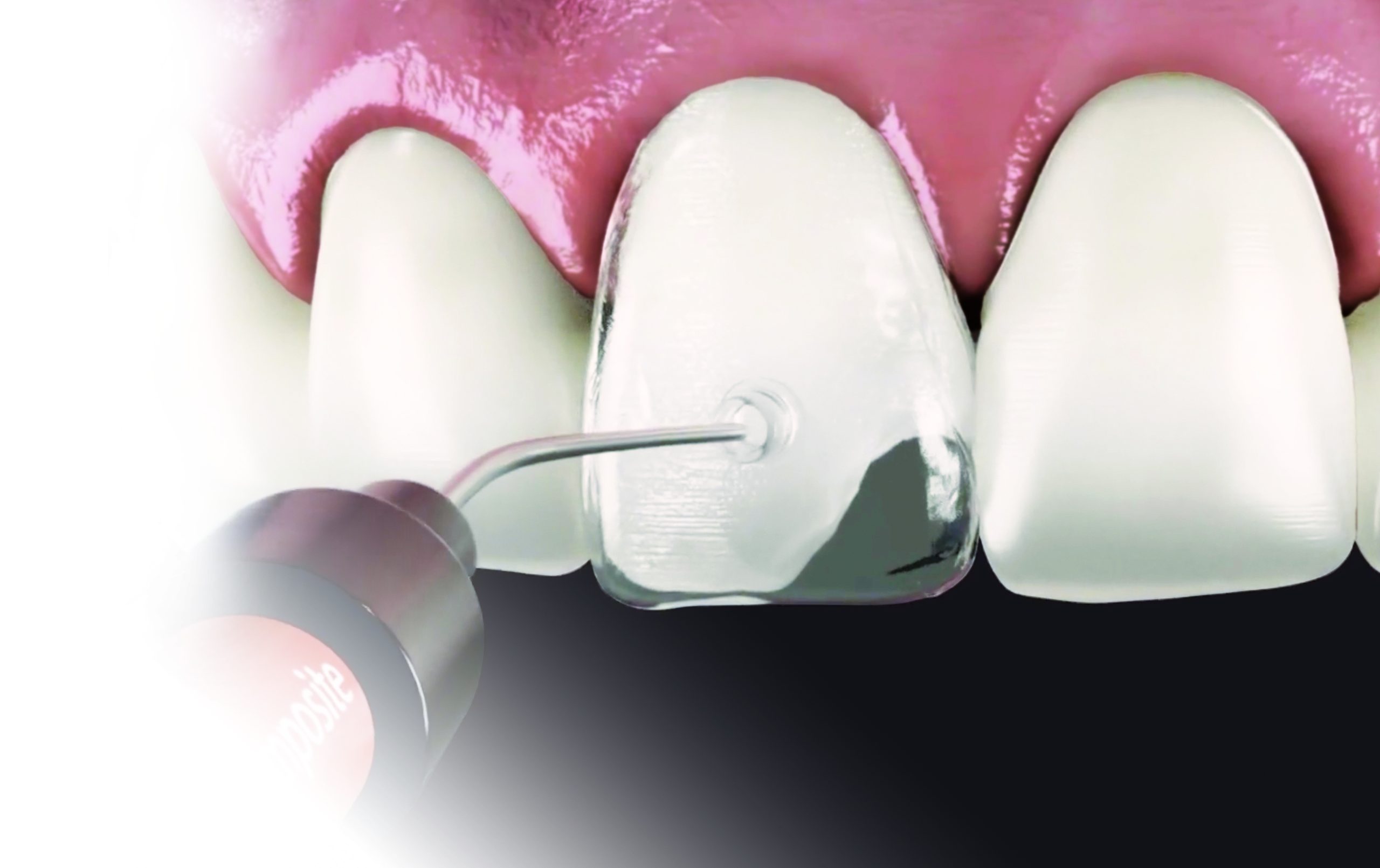 Introducing VeneerNow! Making Composite Veneer Dentistry Easier and More Efficient